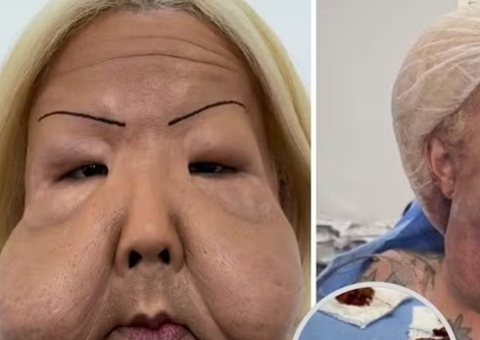 Médico mostra óleo mineral retirado do rosto de Juju do Pix: 'endurecido'