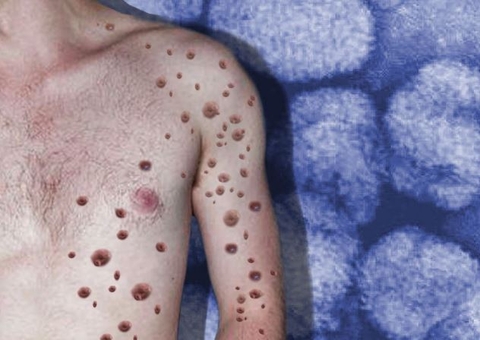 Saiba o estado de saúde de jovem suspeito de contrair varíola dos macacos no Amazonas