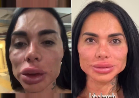 Kamila Simioni viraliza ao surgir inchada e explica: 'não foi harmonização'