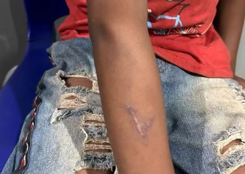 Criança indígena é queimada com ferro de marcar gado por pecuarista