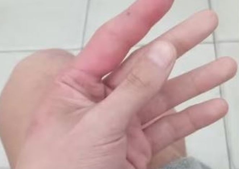 Homem perde o dedo após ser picado por aranha venenosa