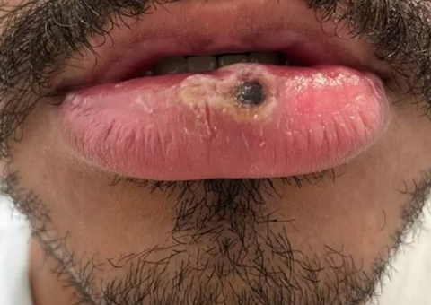 Amazonas registra mais 3 casos suspeitos de varíola dos macacos 