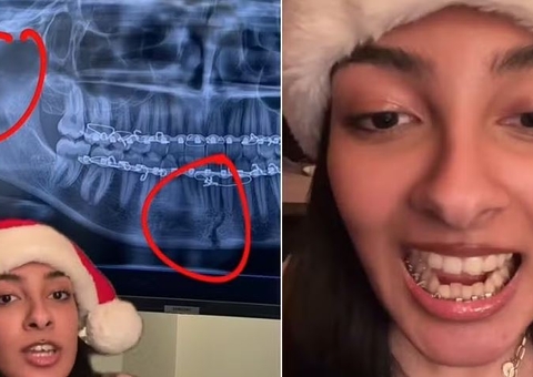 Jovem sofre fratura dupla no maxilar ao mastigar doce