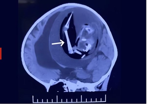 Médicos encontram braço em crânio de bebê que demorou a desenvolver fala