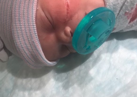 Recém-nascida tem rosto deformado após ser cortada durante cesárea