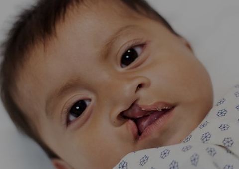 Amazonense é embaixador de ONG mundial que trata fissura labiopalatina