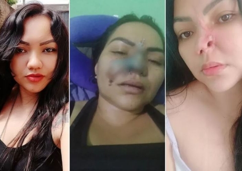 Mulher perde parte do nariz após passar por procedimento estético com dentista