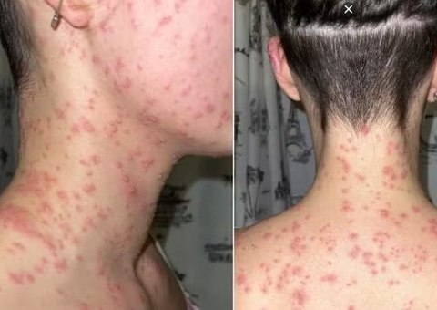 Mulher processa polícia após ser algemada com o rosto em formigueiro