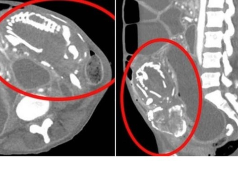 Mulher culpa bruxa antes de morrer por gerar bebê de pedra