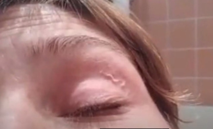 Vídeo mostra caso de ‘verme no olho’, doença rara no Brasil  