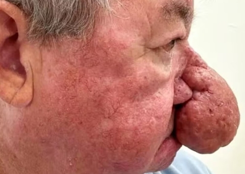 Escocês celebra cirurgia que o permitiu voltar a beijar a esposa