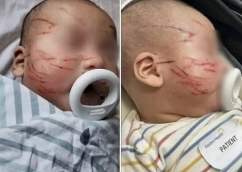 Mãe deixa bebê em creche e encontra criança com mais de 20 arranhões no rosto