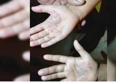 Mãe queima mãos de filhas como castigo por comerem caixa de leite condensado