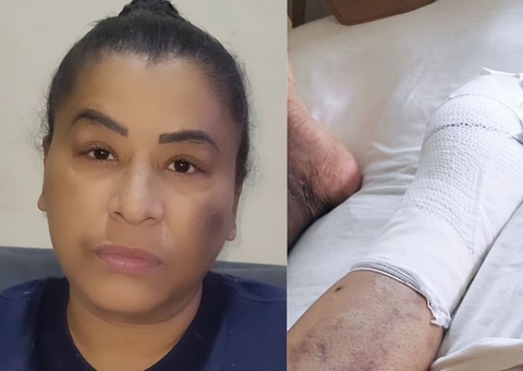 Pioneira do funk, MC Katia amputa pé após retirada de mioma