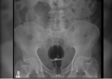 Com lâmpada no ânus, homem passa dias sentindo dores por medo da esposa