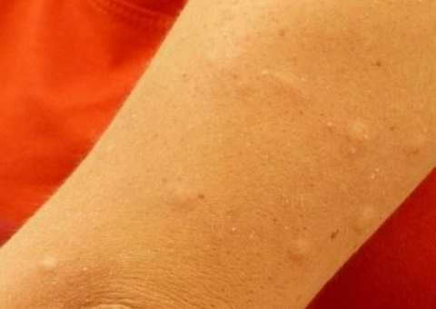 Especialistas dão dicas para ceia de quem tem alergias alimentares