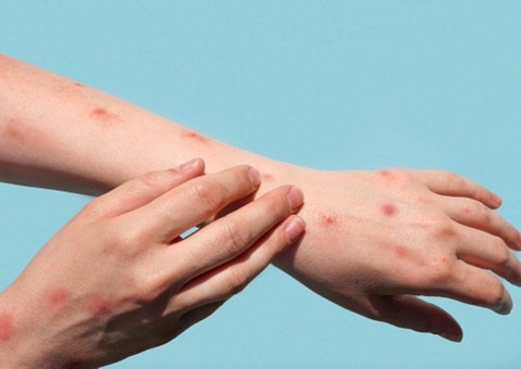 Com 155 confirmados, Amazonas investiga 61 casos suspeitos de Varíola dos Macacos