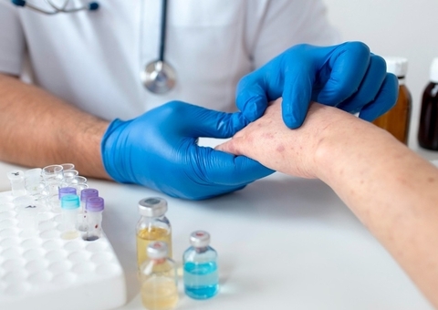 Amazonas tem sete casos confirmados de Mpox, diz FVS