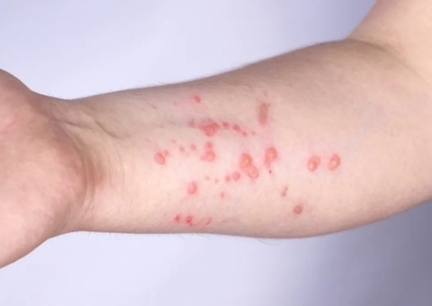 Amazonas tem 67 casos confirmados de Mpox