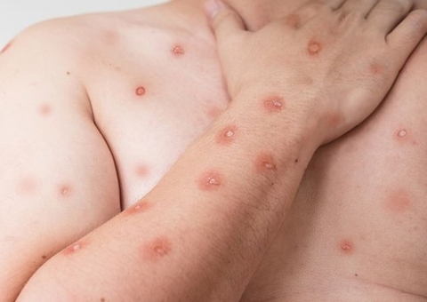 Mpox: Amazonas registra 5 novos casos em janeiro de 2025