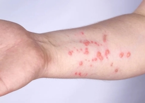 Amazonas completa mais uma semana sem novos casos de Mpox