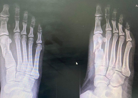 Mulher tem pé quebrado com golpes de capacete pelo ex-namorado 