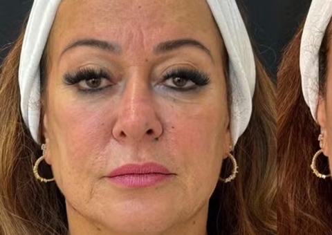  Mãe de Neymar faz rejuvenescimento facial com rinomodelação e mais; fotos