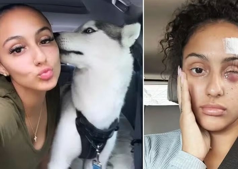 Mulher perde olho após guia de cachorro se soltar durante passeio