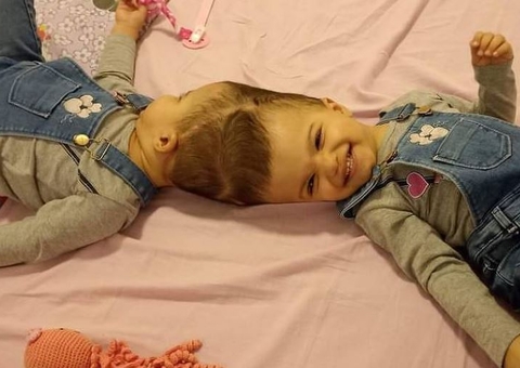 Bebês siamesas unidas pela cabeça são separadas após 25 horas de cirurgia