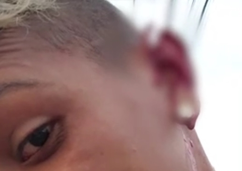 Gari tem orelha rasgada por morador durante briga por saco de lixo