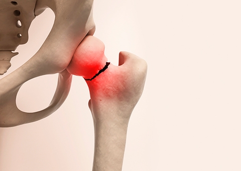 Osteoporose: ossos frágeis que podem matar silenciosamente