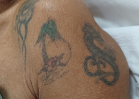 HPS João Lúcio busca familiares de três pacientes vítimas de atropelamento