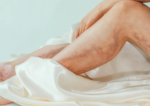 Especialista dá dicas para evitar doenças que afetam os vasos sanguíneos