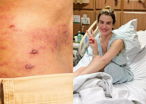 Saiba tudo sobre Herpes-zóster, doença diagnosticada em Fernanda Keulla