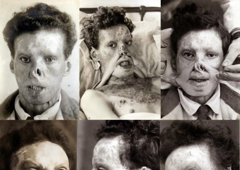 Cirurgias plásticas foram criadas para atender soldados feridos em guerra