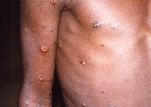 Caso de varíola dos macacos notificado no interior do Amazonas é descartado