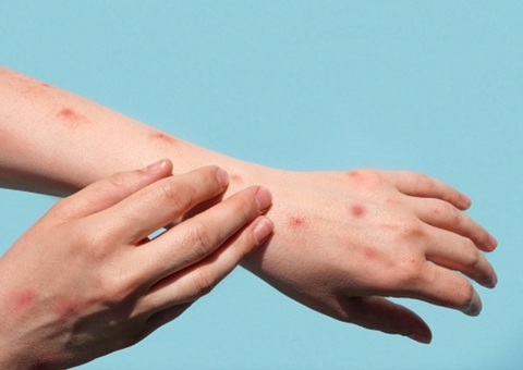 76% dos infectados pela varíola dos macacos no Amazonas fizeram sexo com desconhecidos