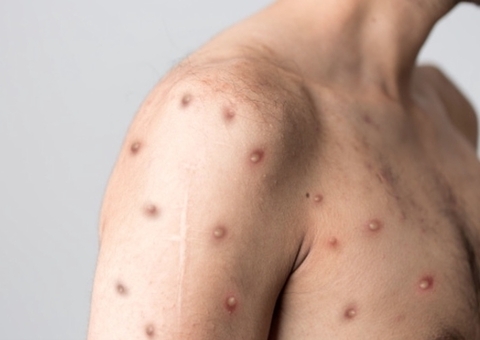 Amazonas chega a 21 casos confirmados de varíola dos macacos nesta segunda