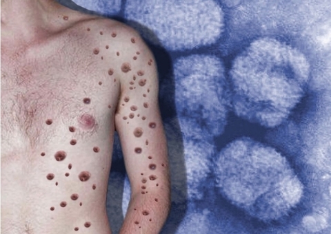 Sobe para 25 o número de casos suspeitos de varíola dos macacos no Amazonas