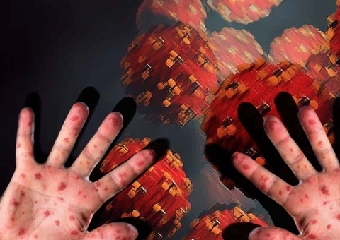 Após 2 anos, Amazonas registra primeiro caso de sarampo em criança