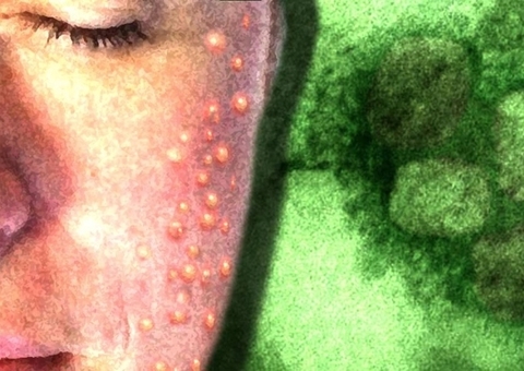 Sobe para seis os casos suspeitos de varíola dos macacos no Brasil 