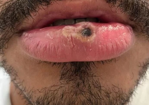 Com mais 4 infectados, Amazonas chega a 309 casos de varíola dos macacos