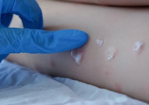 Amazonas registra mais dois casos suspeitos de varíola dos macacos 