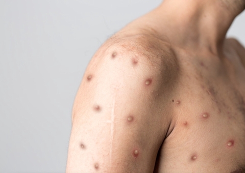 Sobe para 10 o número de casos suspeitos de varíola dos macacos no Amazonas