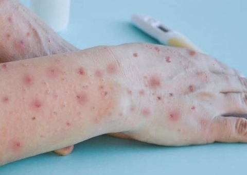 Com 16 infectados, Amazonas tem mais seis casos suspeitos de varíola dos macacos