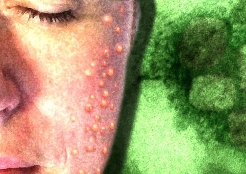 Com mais 8 infectados, Amazonas chega a 97 casos de varíola dos macacos 