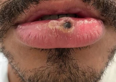 Amazonas confirma mais 3 infectados pela varíola dos macacos nesta terça-feira