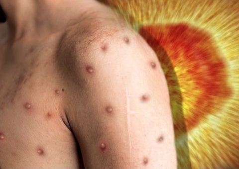 Amazonas confirma terceiro caso de varíola dos macacos