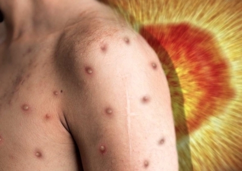 Com 8 novos casos, Amazonas tem 48 infectados pela varíola dos macacos