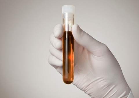 Amazonas tem 119 casos confirmados de rabdomiólise